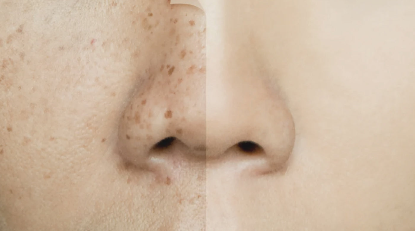 Skincare Myth: Only Older People Get Age Spots